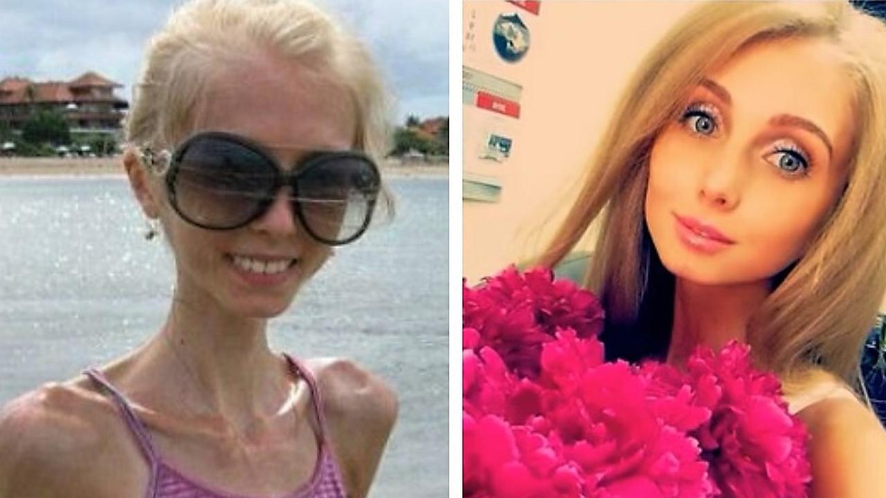 Маша кохно фото до и после анорексии