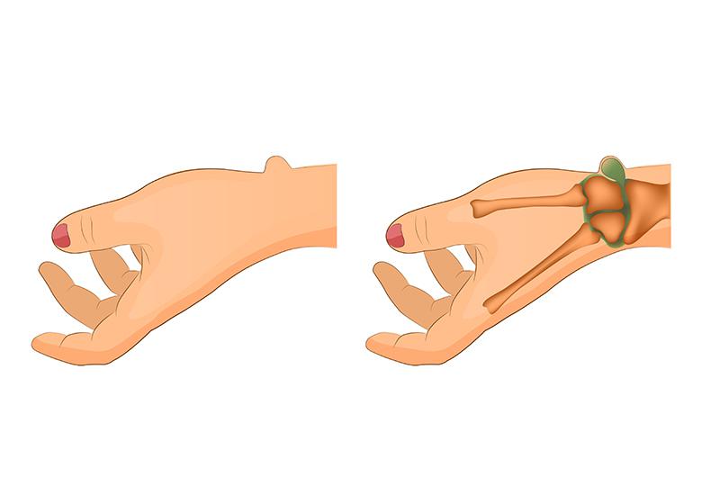 Что такое гигрома. Лечение гигромы кисти руки и других локализаций — клиника «Добробут»